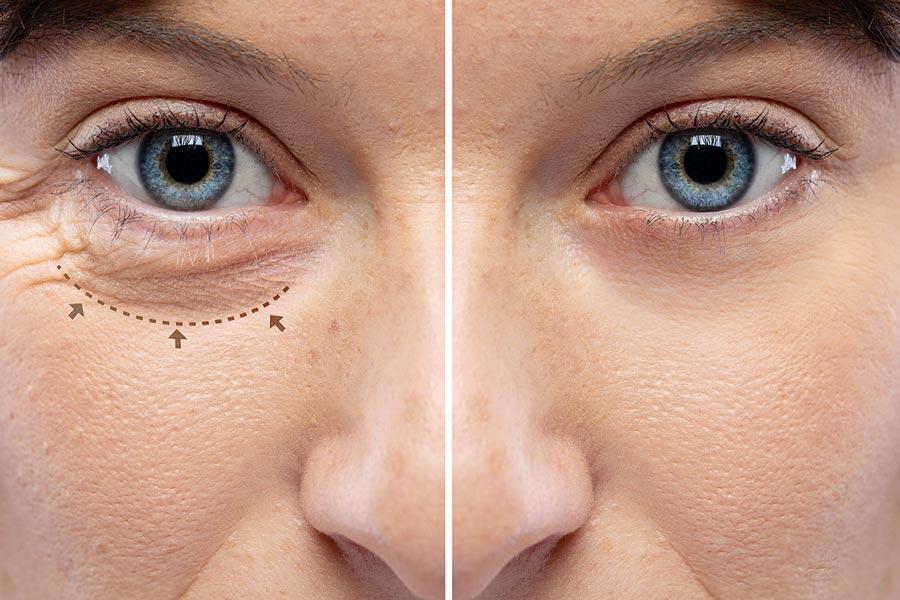 Suctioning puffiness with lower eyelid lift